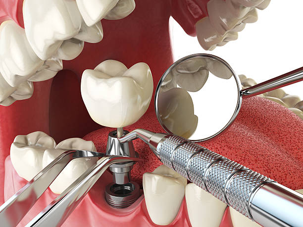 Best Emergency Treatment for Dental Infections or Abscesses in Almont, MI